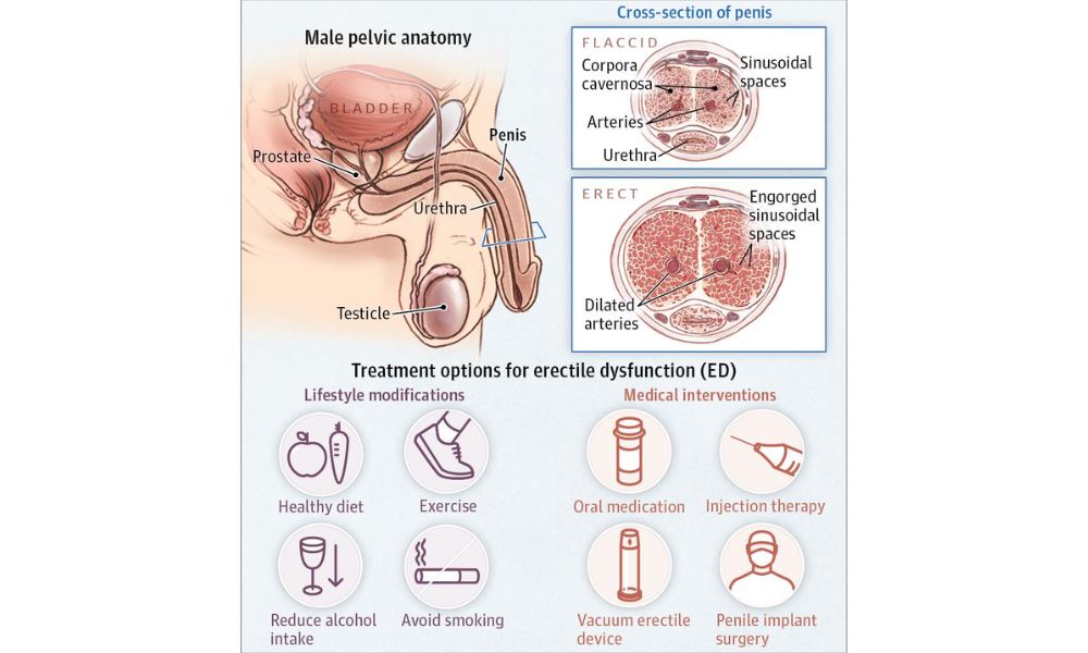 Rối loạn cương dương: Vì sao “muốn mà không được” và nam giới cần làm gì?